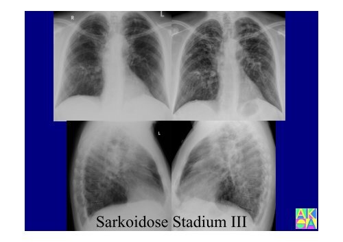 Sarkoidose - Institut für Radiologie, Nuklearmedizin und ...