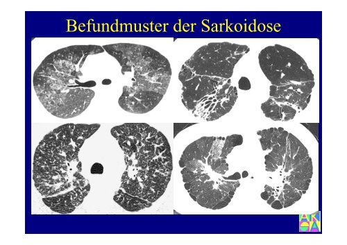 Sarkoidose - Institut für Radiologie, Nuklearmedizin und ...