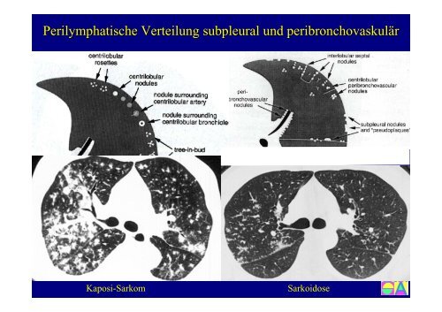 Sarkoidose - Institut für Radiologie, Nuklearmedizin und ...