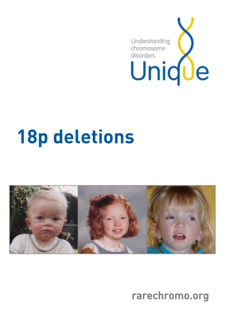 18p deletions FTNW - Unique - The Rare Chromosome Disorder ...