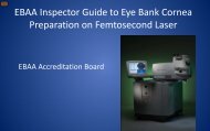 Guide to Cornea Preparation on Femtosecond Laser