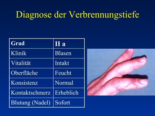 Verbrennungsformen - Rettungsdienst Wetteraukreis