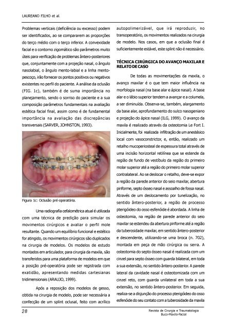 avanço maxilar - Revista de Cirurgia e Traumatologia Buco-Maxilo ...