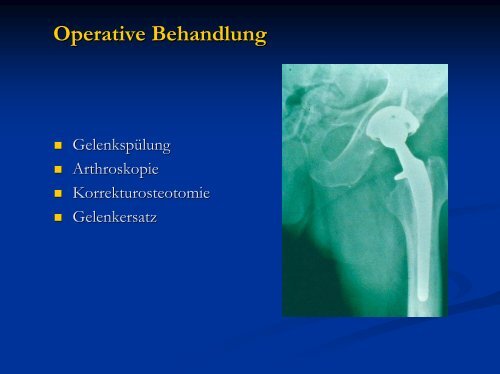 Workshop Arthrose Abklärung und Behandlung - Rheuma Schweiz