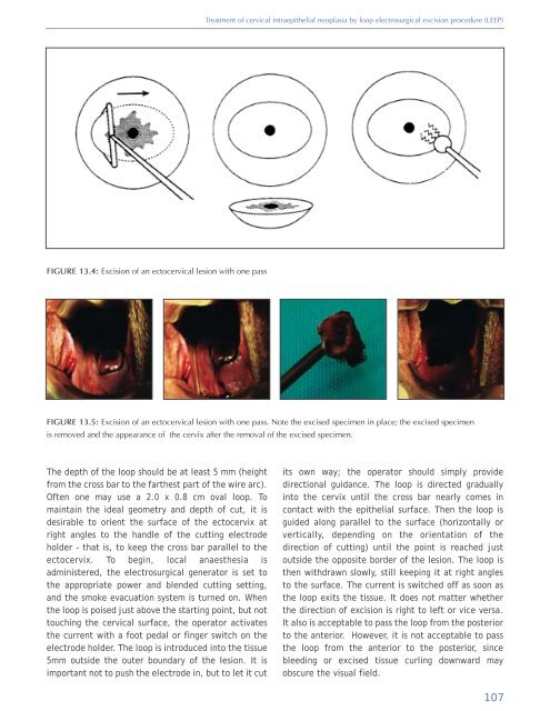 Colposcopy and Treatment of Cervical Intraepithelial Neoplasia - RHO