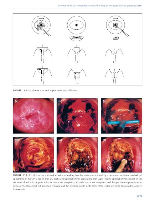 Colposcopy and Treatment of Cervical Intraepithelial Neoplasia - RHO