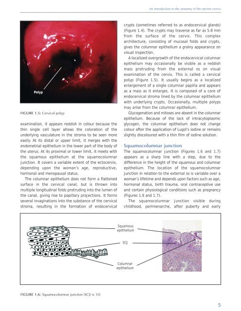 Colposcopy and Treatment of Cervical Intraepithelial Neoplasia - RHO