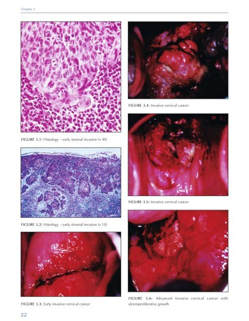 Colposcopy and Treatment of Cervical Intraepithelial Neoplasia - RHO