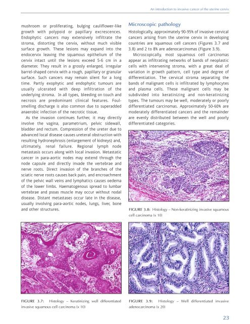 Colposcopy and Treatment of Cervical Intraepithelial Neoplasia - RHO