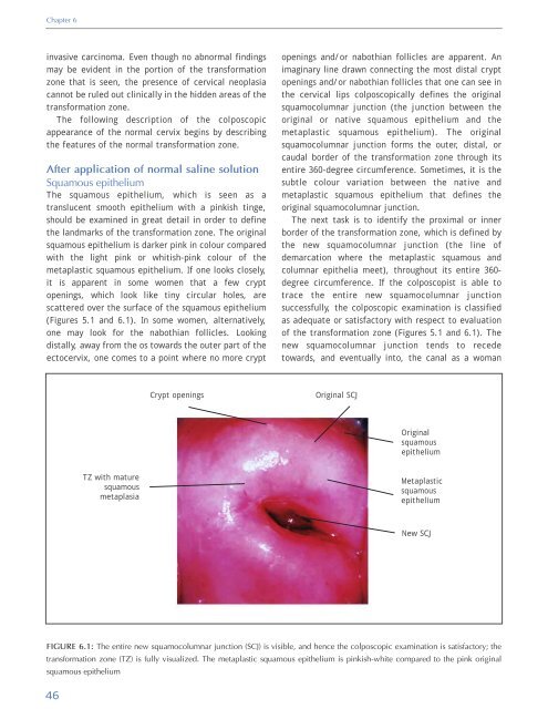 Colposcopy and Treatment of Cervical Intraepithelial Neoplasia - RHO