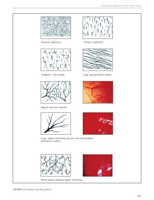 Colposcopy and Treatment of Cervical Intraepithelial Neoplasia - RHO