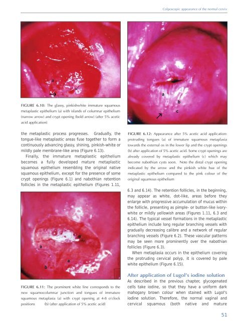 Colposcopy and Treatment of Cervical Intraepithelial Neoplasia - RHO