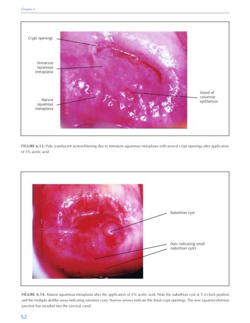 Colposcopy and Treatment of Cervical Intraepithelial Neoplasia - RHO