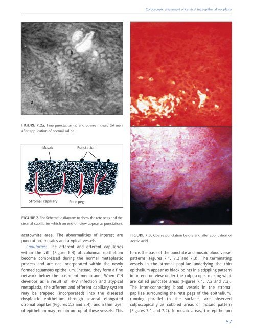 Colposcopy and Treatment of Cervical Intraepithelial Neoplasia - RHO