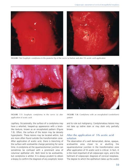 Colposcopy and Treatment of Cervical Intraepithelial Neoplasia - RHO