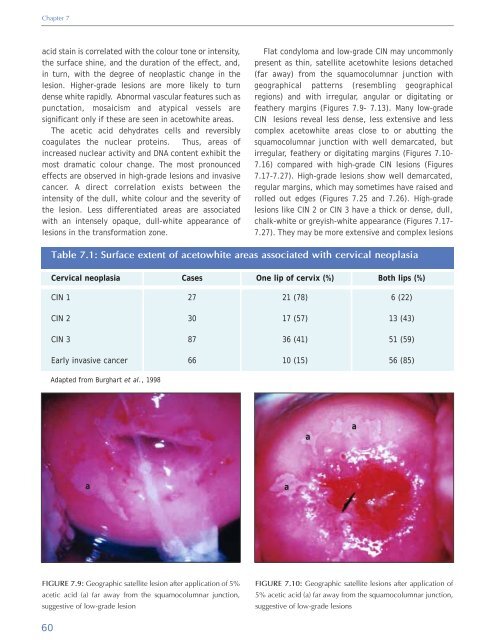 Colposcopy and Treatment of Cervical Intraepithelial Neoplasia - RHO