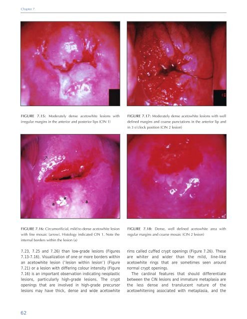 Colposcopy and Treatment of Cervical Intraepithelial Neoplasia - RHO