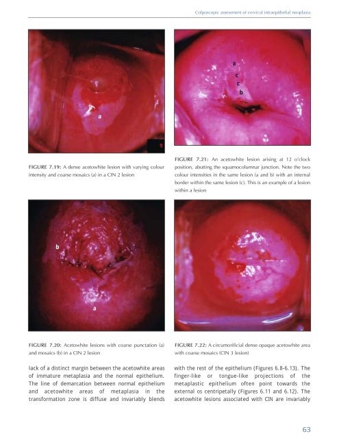 Colposcopy and Treatment of Cervical Intraepithelial Neoplasia - RHO