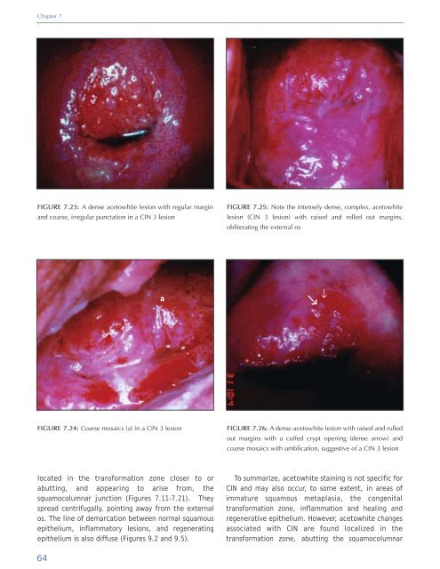 Colposcopy and Treatment of Cervical Intraepithelial Neoplasia - RHO