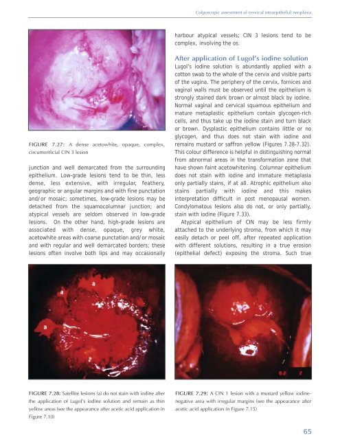 Colposcopy and Treatment of Cervical Intraepithelial Neoplasia - RHO