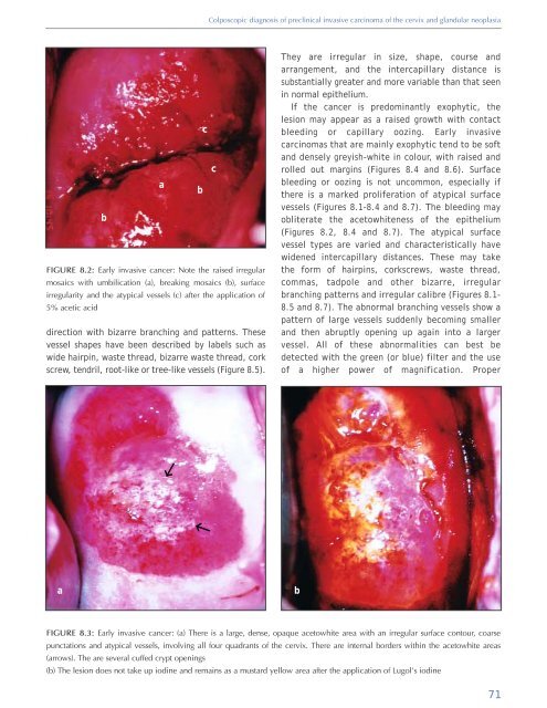 Colposcopy and Treatment of Cervical Intraepithelial Neoplasia - RHO