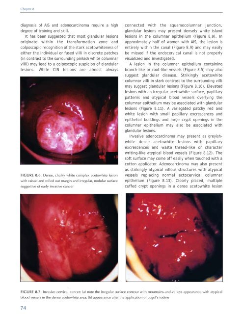 Colposcopy and Treatment of Cervical Intraepithelial Neoplasia - RHO