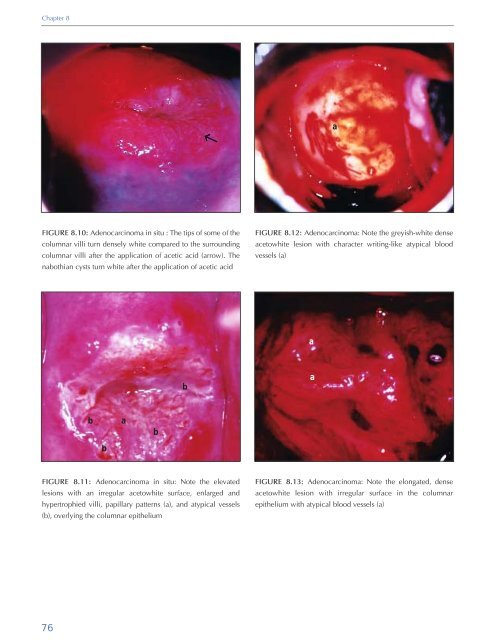 Colposcopy and Treatment of Cervical Intraepithelial Neoplasia - RHO