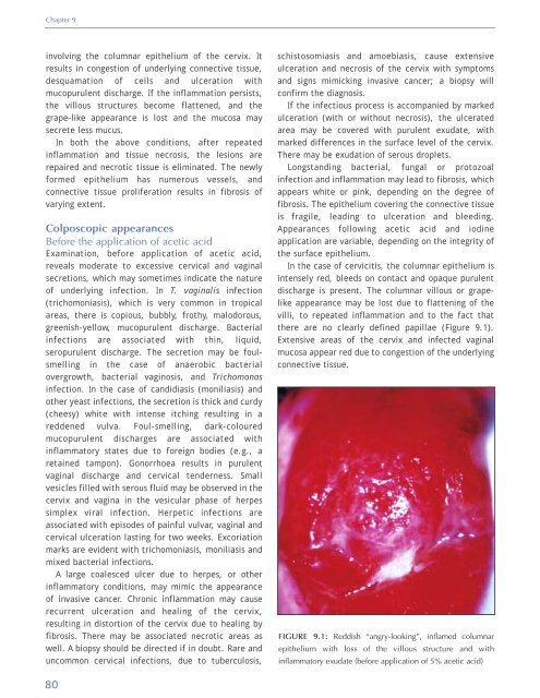 Colposcopy and Treatment of Cervical Intraepithelial Neoplasia - RHO