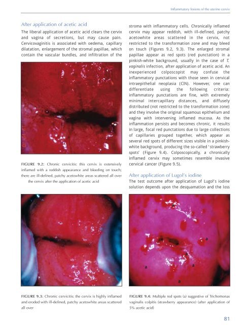 Colposcopy and Treatment of Cervical Intraepithelial Neoplasia - RHO