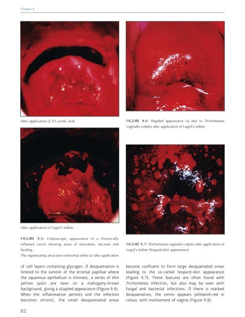 Colposcopy and Treatment of Cervical Intraepithelial Neoplasia - RHO