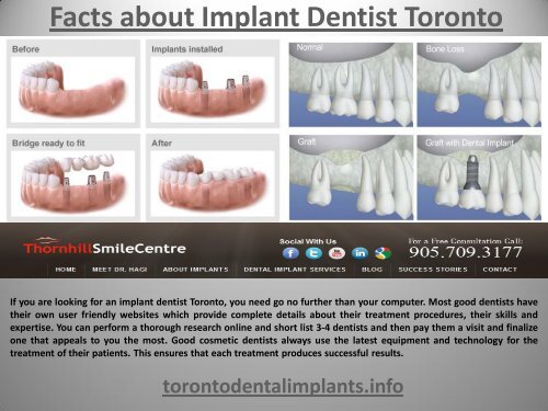 Facts about Implant Dentist Toronto