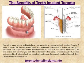 The Benefits of Teeth Implant Toronto
