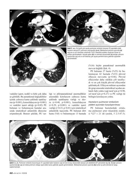 Akut pulmoner embolizm ile parankimal ve plevral anormalliklerin ...