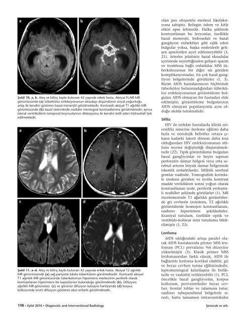 AIDS'te merkezi sinir sistemi tutulumunun gÃ¶rÃ¼ntÃ¼leme bulgularÄ±