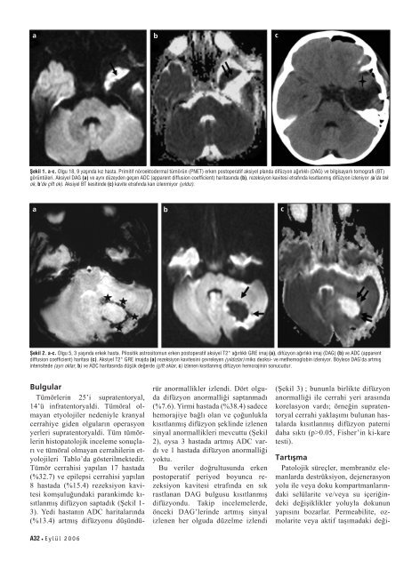 Erken postoperatif beyin difÃ¼zyon aÄÄ±rlÄ±klÄ± MR gÃ¶rÃ¼ntÃ¼leme ile ...