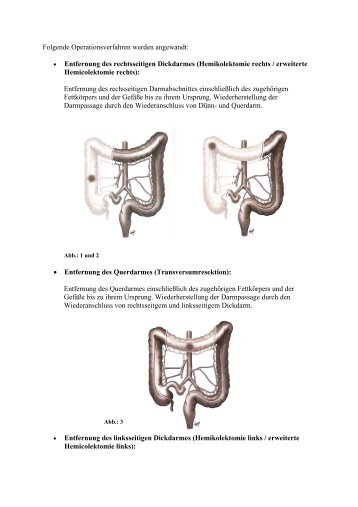 Operationsverfahren bei Kolonkarzinom - RoMed Kliniken