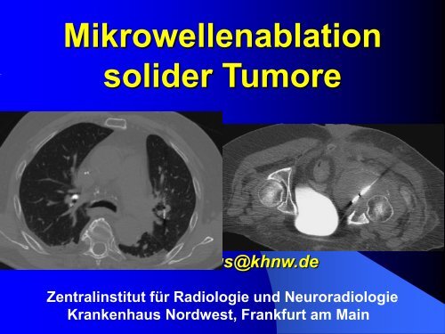 Mikrowellenablation solider Tumoren – was spricht dafür? - Saint