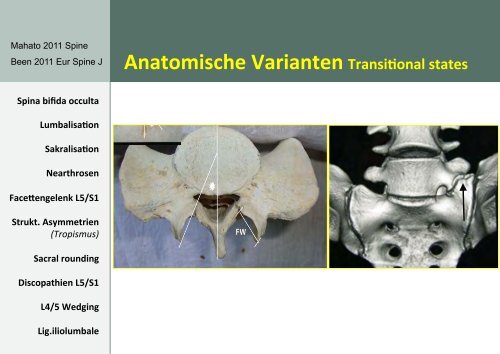 RÃ¼ckenschmerzen bei Spondylolisthesis ... - bei der SAMM