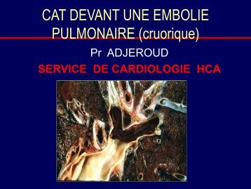 CAT DEVANT UNE EMBOLIE PULMONAIRE