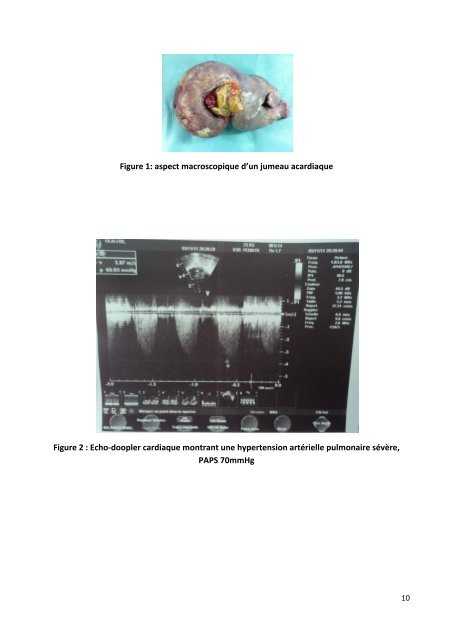 le syndrome transfuseur transfuse : physiopathologie, diagnostic et ...