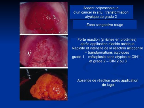 Cancer du col utÃ©rin ÃpidÃ©miologie, diagnostic, traitement,dÃ©pistage