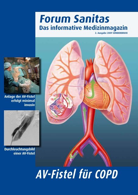 AV-Fistel fÃ¼r COPD