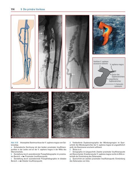 114 9 Die primäre Varikose - Schattauer