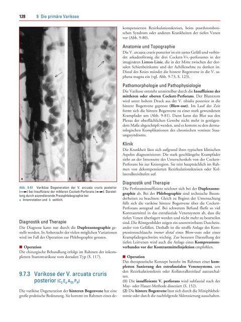114 9 Die primäre Varikose - Schattauer