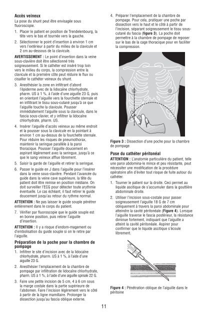 Denver Ascites Shunt PAK 42-2050/42-2055 - CareFusion