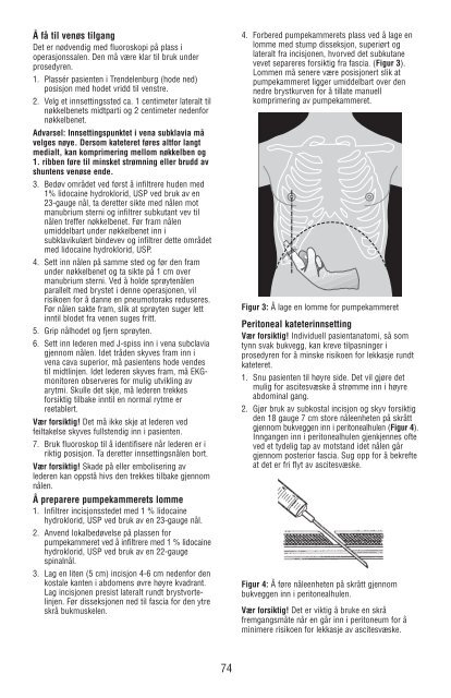 Denver Ascites Shunt PAK 42-2050/42-2055 - CareFusion