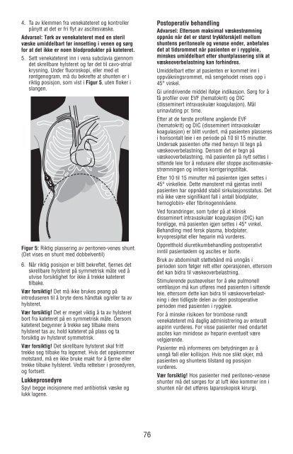 Denver Ascites Shunt PAK 42-2050/42-2055 - CareFusion