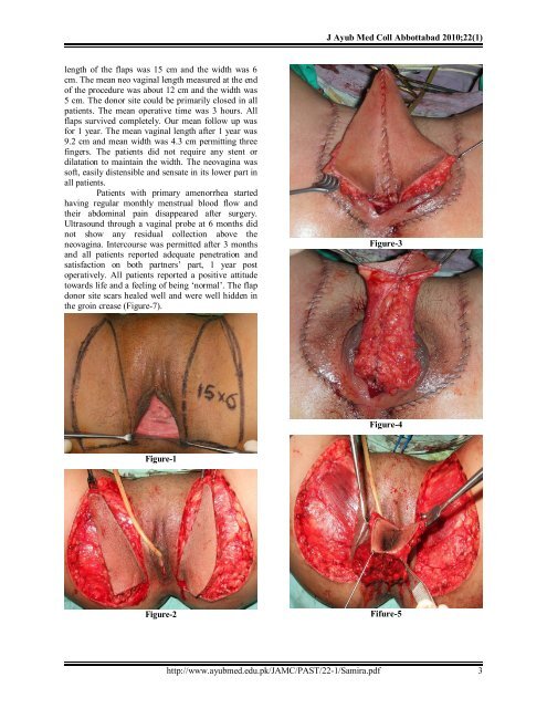 vaginoplasty with bilateral islanded pudendal thigh flaps