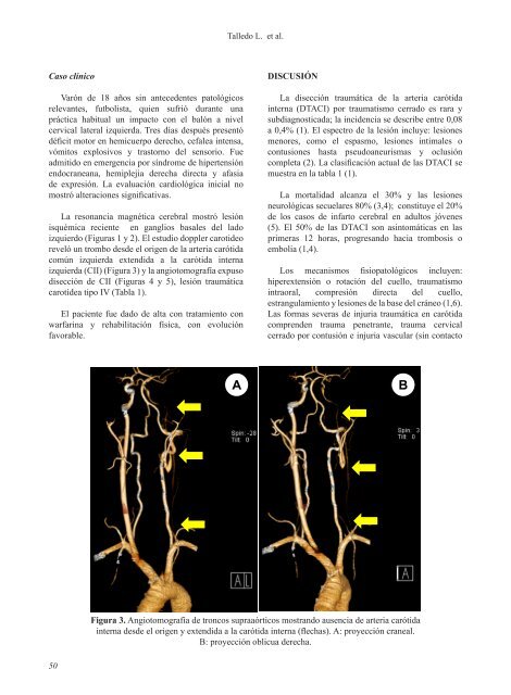 DisecciÃ³n traumÃ¡tica de la arteria carÃ³tida interna y ... - SciELO