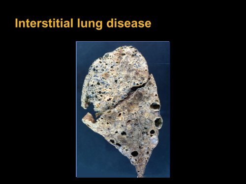 Lung and pulmonary vascular disease in scleroderma, the role of ...
